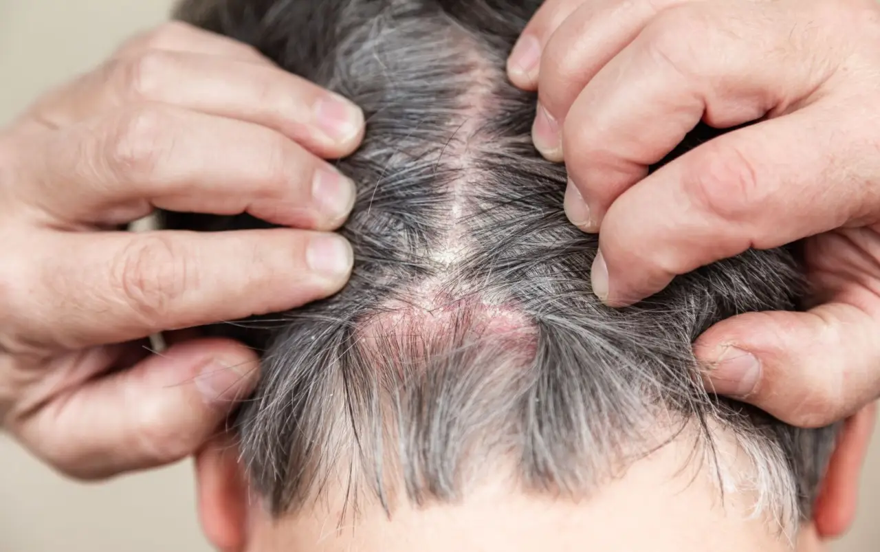 Dermatite seborroica: quali soluzioni antistaminiche sono davvero efficaci e cosa sapere sulle opzioni disponibili