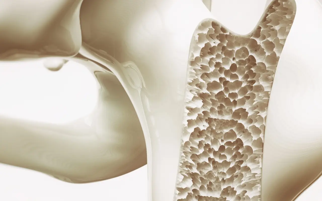 Osteoporosi: ecco i valori da tenere d’occhio per perdere punti e salute delle ossa