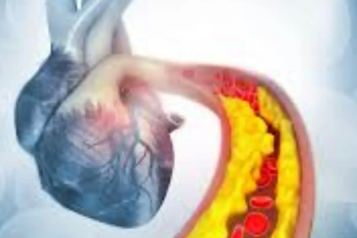 Che cos’è la cardiopatia vascolare ischemica cronica? La malattia silenziosa che colpisce il cuore