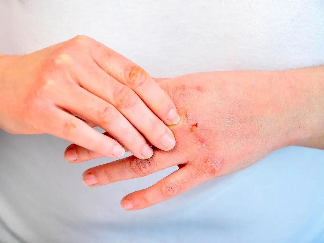 Soffri di psoriasi? Non commettere mai questo errore comune o peggiorerai la situazione